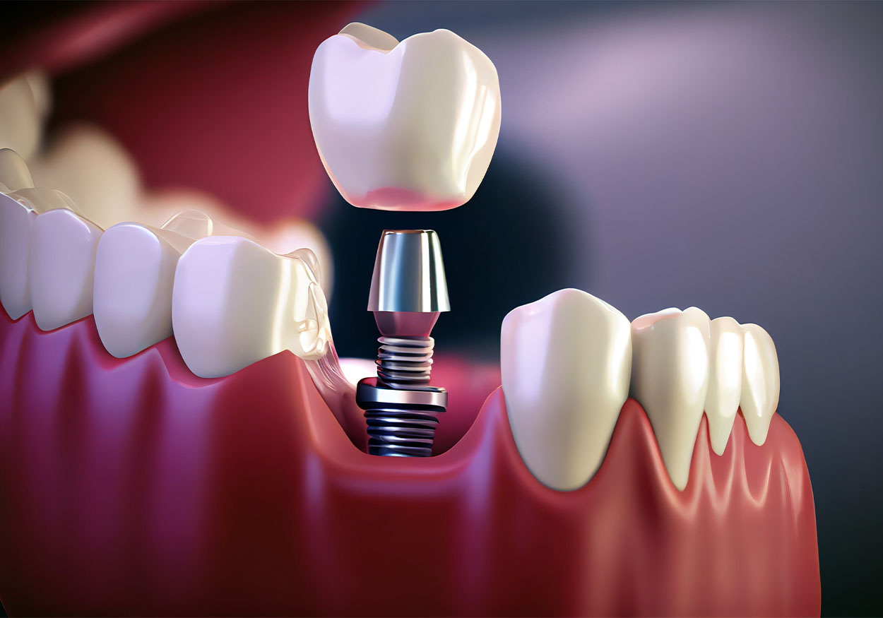 implant