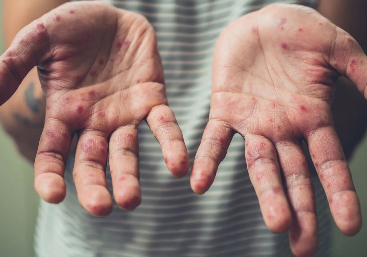 Bakan Koca'dan 'Kızamık Vakaları' Açıklaması! 2 kızamak